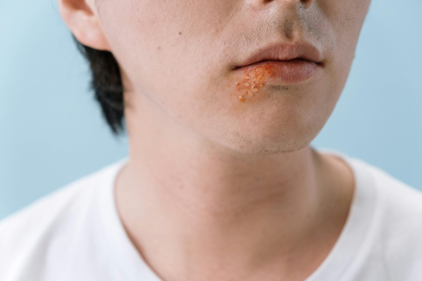 A close-up image of a person's lips showing a cold sore on the lower lip area.