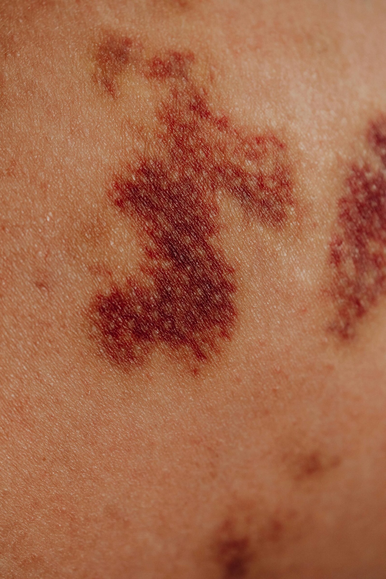 Detailed close-up view of bruising on skin, showing texture and color variations.